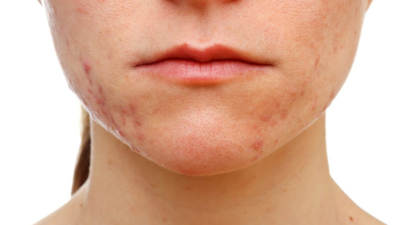 Sivilceler için evde doğal maske tarifi