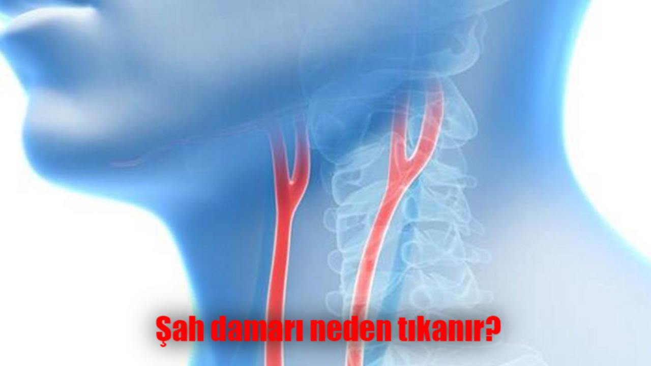 Şah damarı neden tıkanır? Şah damarı tıkanırsa ne olur, öldürür mü?