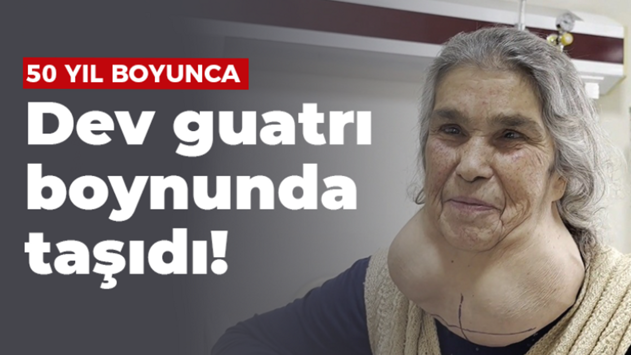 50 yıl boyunca dev guatrı boynunda taşıdı!