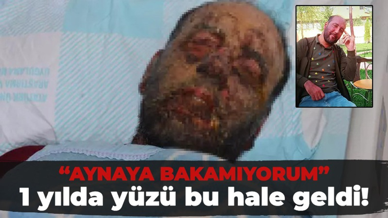 Bir milyonda 2 görülen hastalık pençesine aldı! “Aynaya bakamıyorum”