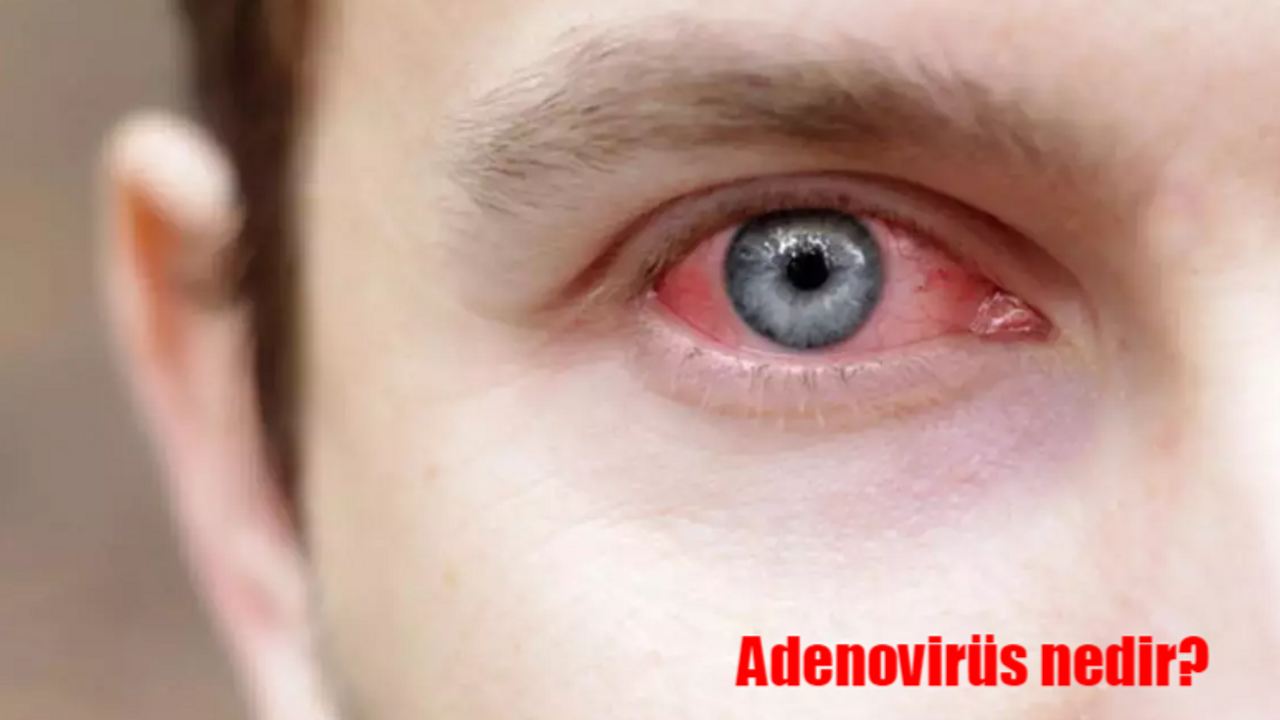 Adenovirüs nedir? Adenovirüs nasıl bulaşır, belirtileri nelerdir?