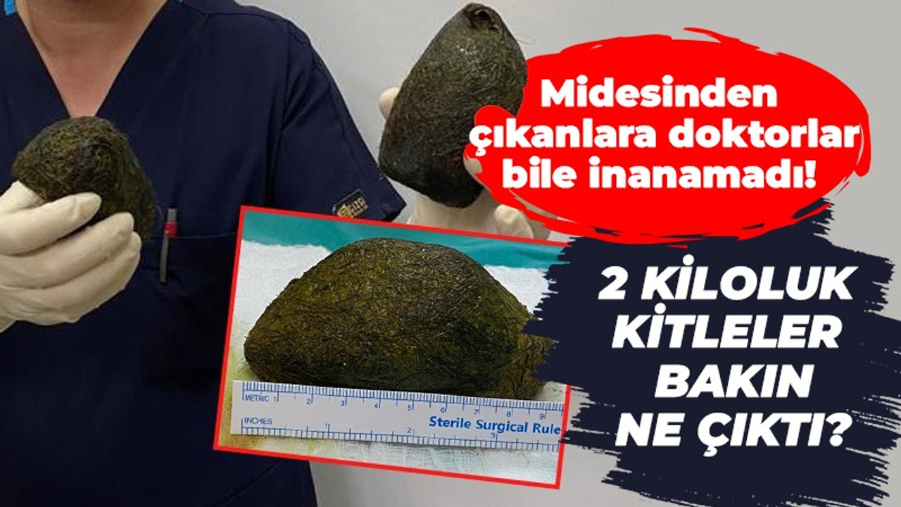 Midesinden çıkanlara doktorlar bile inanamadı! 2 kiloluk kitleler bakın ne çıktı?