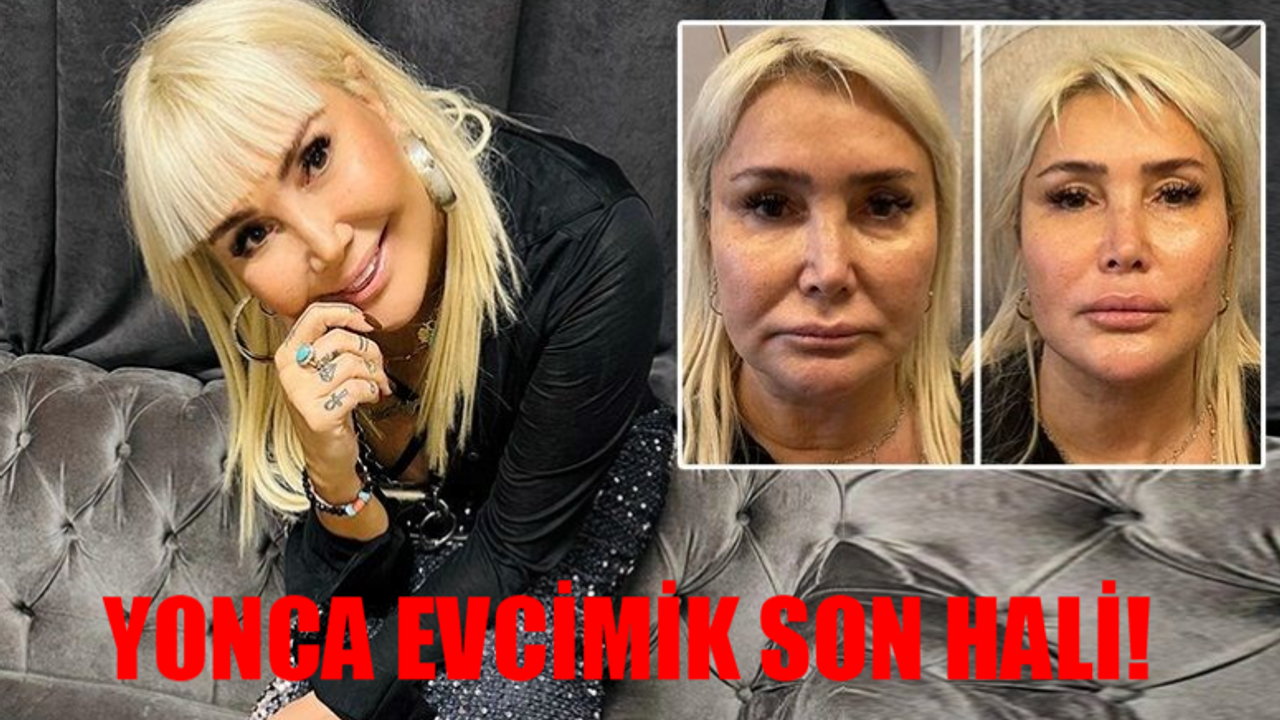 Yonca Evcimik Son Hali Görenlerin Gözleri Yuvalarından Fırladı! 60'lık Yoncimik 18'lik Çıtır Oldu! Yonca Evcimik Estetik Pozları Peş Peşe Geldi