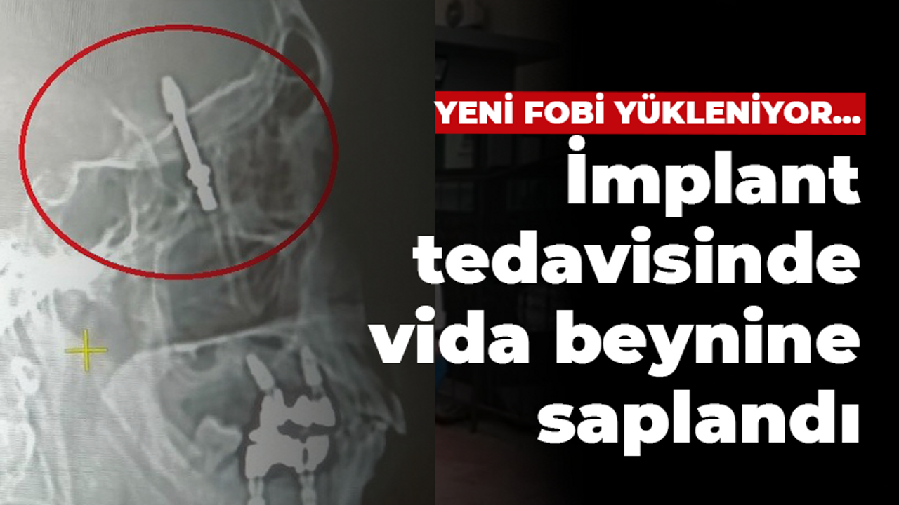 Yeni fobi yükleniyor! İmplant tedavisinde vida beynine saplandı!