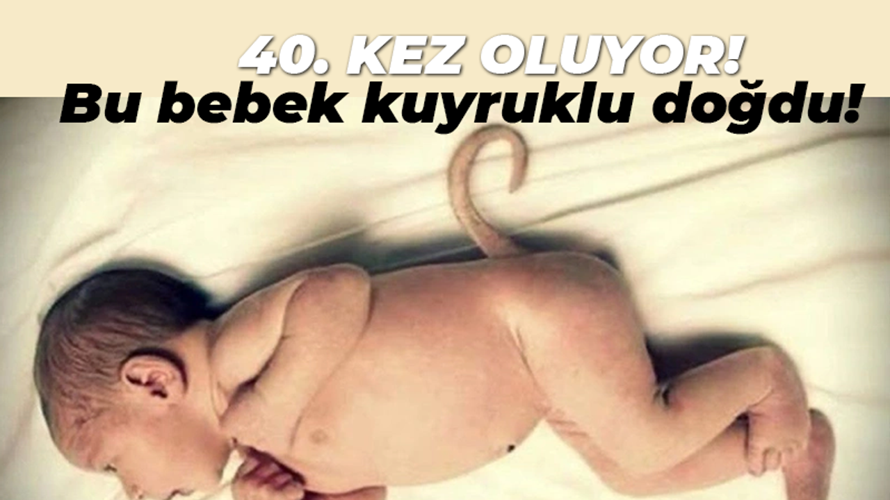 40. kez oluyor! Bu bebek kuyruklu doğdu