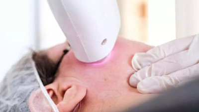 Lazer epilasyonun riskleri nelerdir?