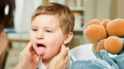 Strep A nedir? Belirtileri ve tedavisi