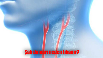 Şah damarı neden tıkanır? Şah damarı tıkanırsa ne olur, öldürür mü?