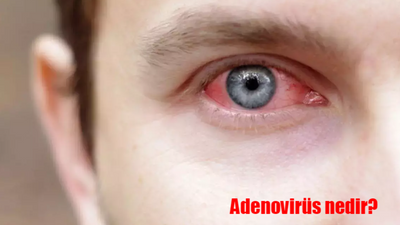 Adenovirüs nedir? Adenovirüs nasıl bulaşır, belirtileri nelerdir?