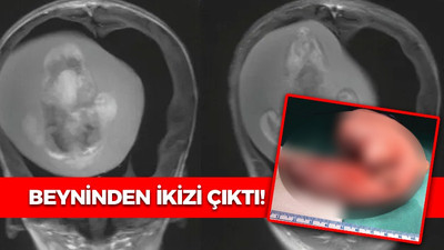 Beyninden ikizi çıktı!