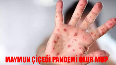 MAYMUN ÇİÇEĞİ PANDEMİ OLUR MU? MPOX Maymun Çiçeği Türkiye'de Var Mı? Maymun Çiçeği Karantina Olacak Mı?