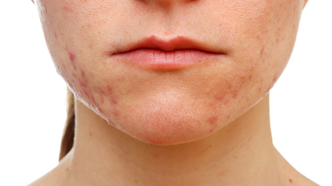 Sivilceler için evde doğal maske tarifi